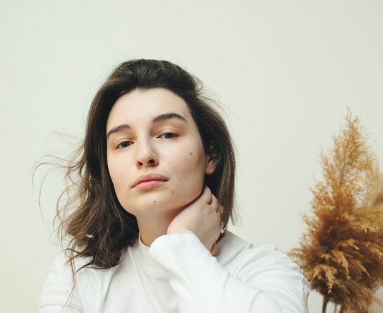 woman with acne
